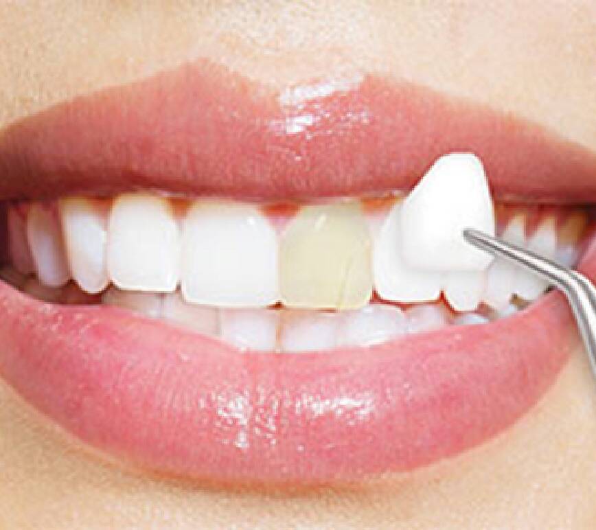 No-Prep Lite Dentistry