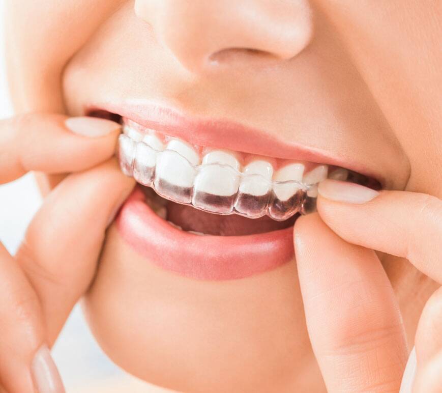 Invisalign clear aligners